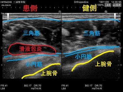 自宅でできる肩滑液包炎の治療法