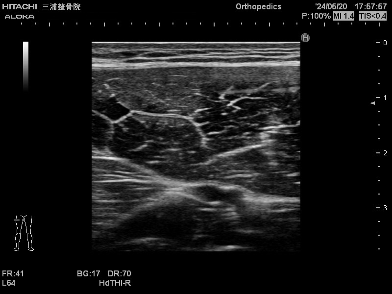 大腿直筋２